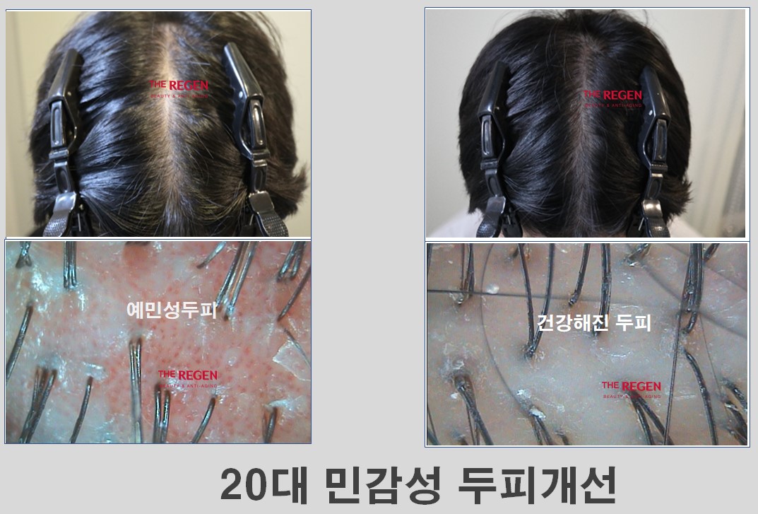 20대 민감성두피 before after 현미경